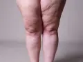 Jambes présentant des signes de lipœdème. Exploration des options de lipœdème traitement naturel pour soulager les symptômes.