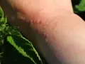 Une peau rougie et irritée suite à une piqure d'ortie, avec des feuilles vertes en premier plan.