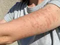 Bras couvert de plaques rouges et surélevées, symptômes d'une allergie cutanée urticaire.