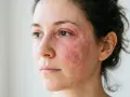 Visage d'une femme avec une peau rouge et irritée autour des yeux et sur les joues, possiblement une allergie au collagène.