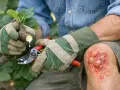 Gants verts protégeant des mains qui taillent une branche de figuier d'où coule la seve de figuier. Le genou porte une blessure avec des cloques.