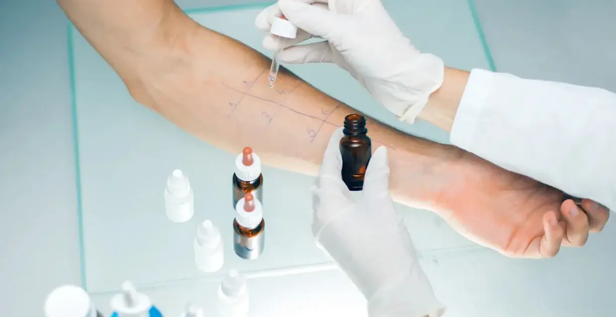 Test cutané pour la **désensibilisation allergies**. Un bras est marqué de cases où des gouttes sont appliquées.