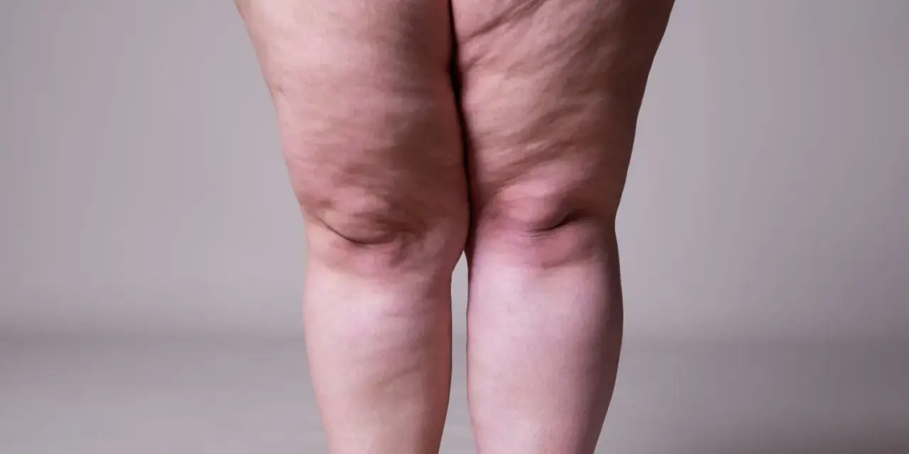 Jambes présentant des signes de lipœdème. Exploration des options de lipœdème traitement naturel pour soulager les symptômes.