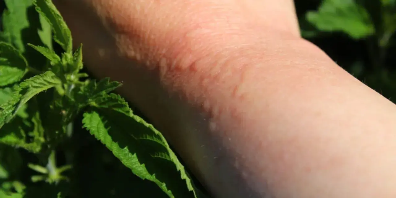 Une peau rougie et irritée suite à une piqure d'ortie, avec des feuilles vertes en premier plan.