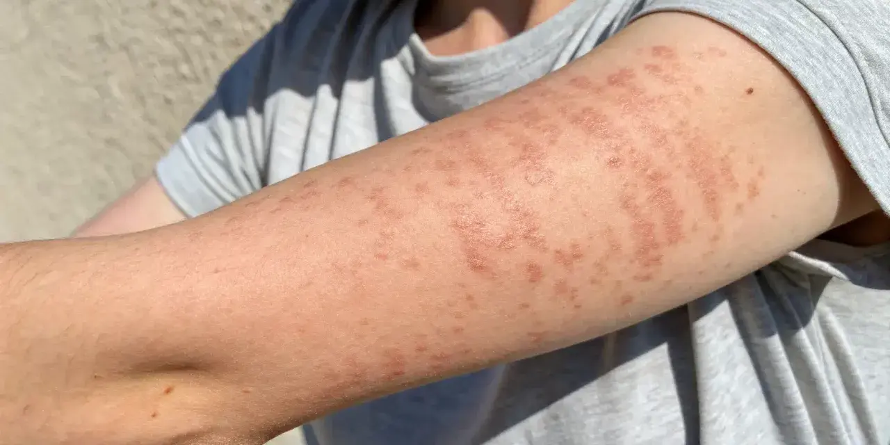 Bras couvert de plaques rouges et surélevées, symptômes d'une allergie cutanée urticaire.