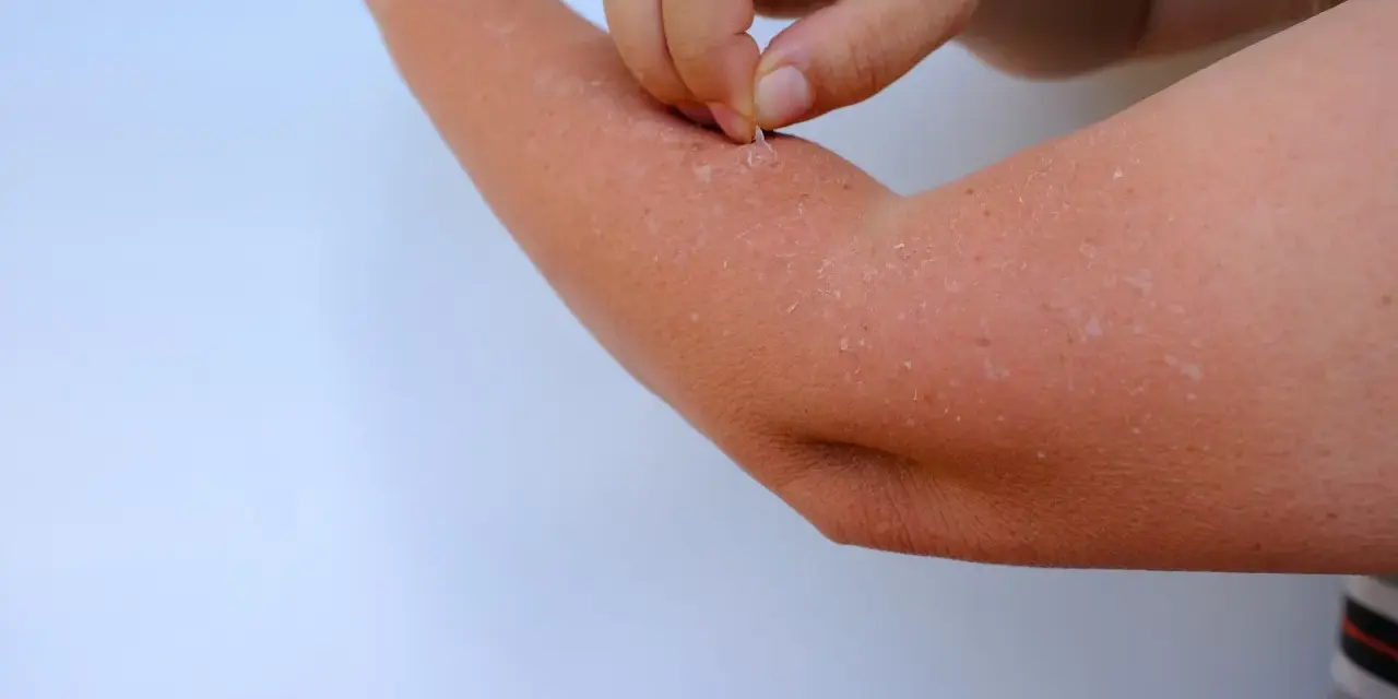 Peau qui pèle sur un bras, peut-être une allergie clementine. Un doigt retire des squames.