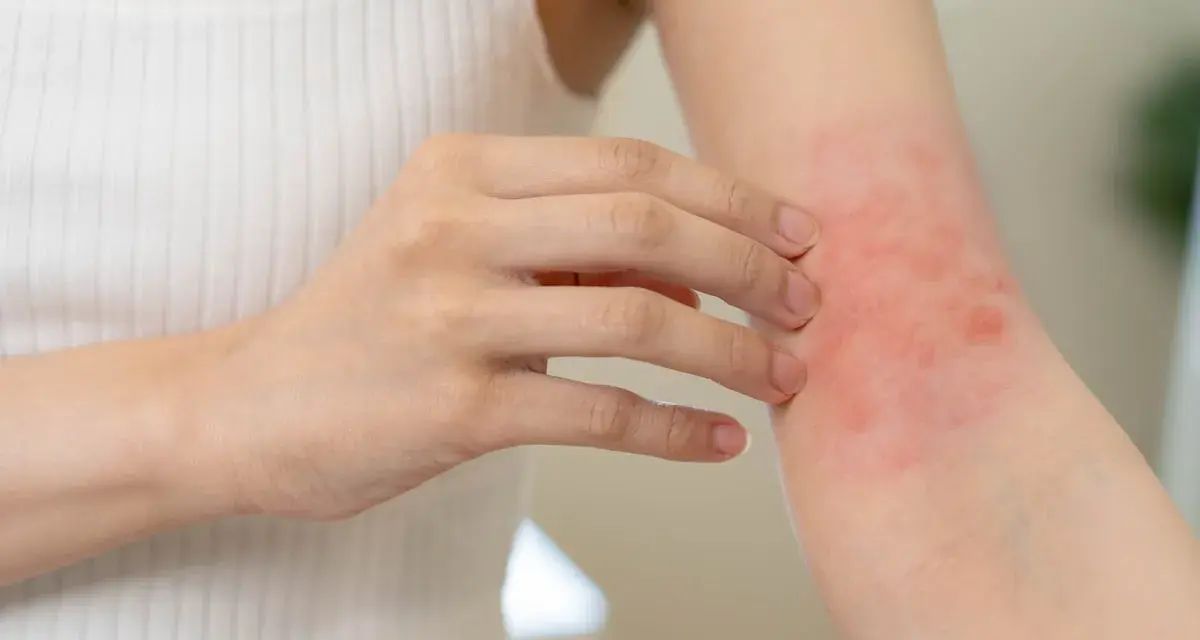 Une personne se gratte le bras, montrant une éruption cutanée rouge. Cela pourrait être un symptôme d'allergie orange.