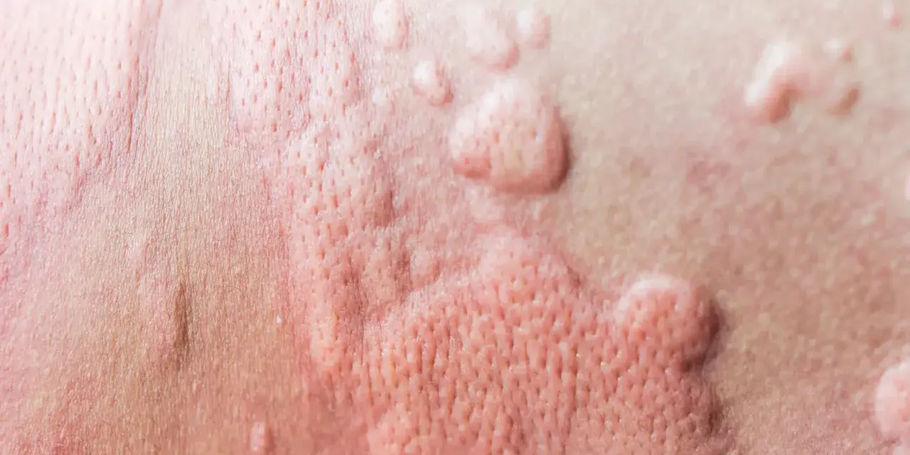 Peau rougie avec des boutons, signe d'urticaire due à la chaleur et à la transpiration.
