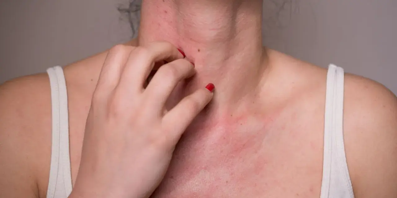 Une personne se gratte le cou et la poitrine, montrant une éruption cutanée rouge. Cela pourrait être une allergie noisette.