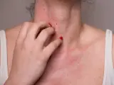 Une personne se gratte le cou et la poitrine, montrant une éruption cutanée rouge. Cela pourrait être une allergie noisette.
