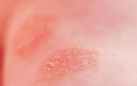 Peau irritée et squameuse, peut-être une allergie au chocolat.