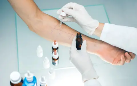 Test cutané pour la **désensibilisation allergies**. Un bras est marqué de cases où des gouttes sont appliquées.