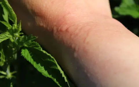 Une peau rougie et irritée suite à une piqure d'ortie, avec des feuilles vertes en premier plan.