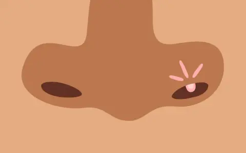 Un bouton de fièvre sur le nez, un remède de grand-mère pour le faire disparaître.