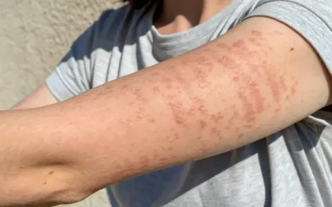 Bras couvert de plaques rouges et surélevées, symptômes d'une allergie cutanée urticaire.