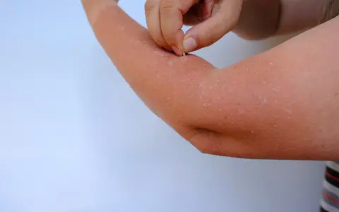 Peau qui pèle sur un bras, peut-être une allergie clementine. Un doigt retire des squames.