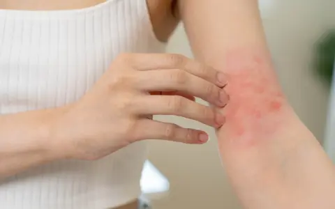 Une personne se gratte le bras, montrant une éruption cutanée rouge. Cela pourrait être un symptôme d'allergie orange.