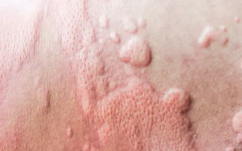 Peau rougie avec des boutons, signe d'urticaire due à la chaleur et à la transpiration.