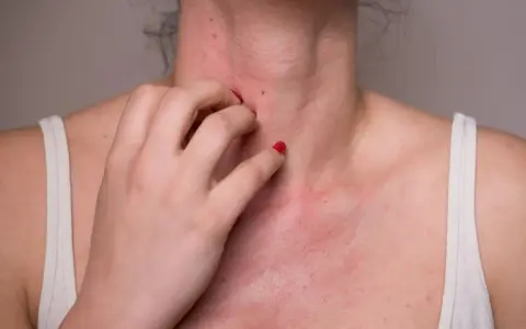 Une personne se gratte le cou et la poitrine, montrant une éruption cutanée rouge. Cela pourrait être une allergie noisette.