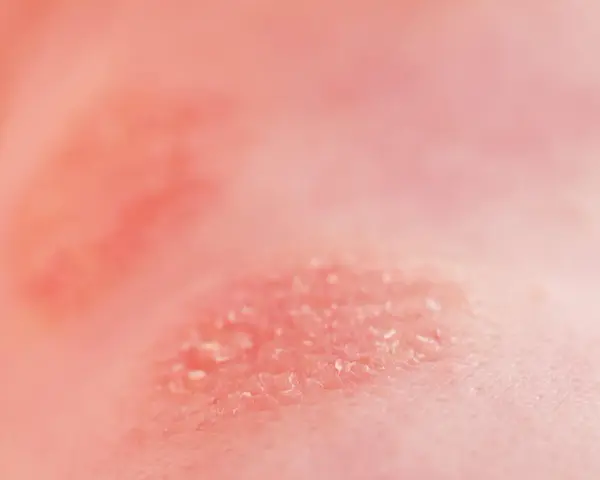 Peau irritée et squameuse, peut-être une allergie au chocolat.