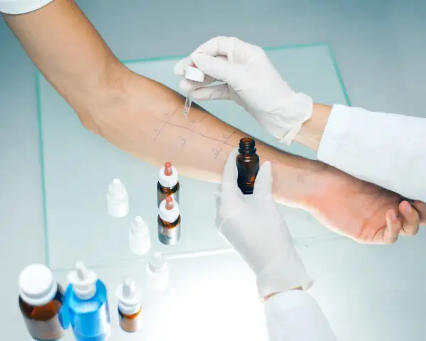 Test cutané pour la **désensibilisation allergies**. Un bras est marqué de cases où des gouttes sont appliquées.