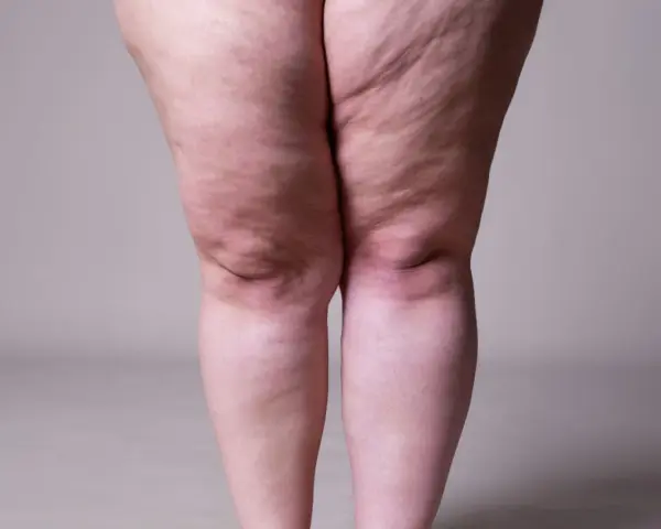 Jambes présentant des signes de lipœdème. Exploration des options de lipœdème traitement naturel pour soulager les symptômes.