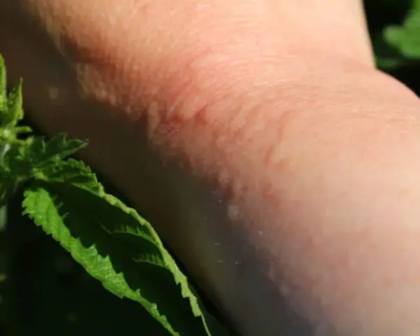 Une peau rougie et irritée suite à une piqure d'ortie, avec des feuilles vertes en premier plan.