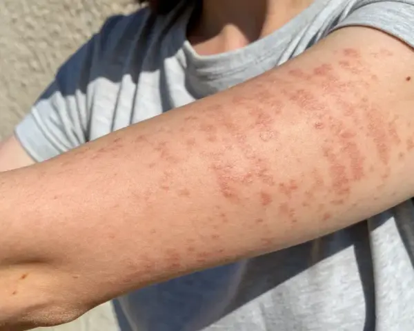 Bras couvert de plaques rouges et surélevées, symptômes d'une allergie cutanée urticaire.