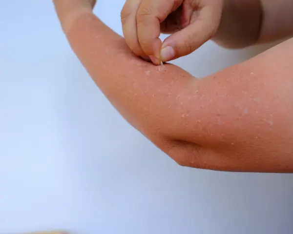 Peau qui pèle sur un bras, peut-être une allergie clementine. Un doigt retire des squames.