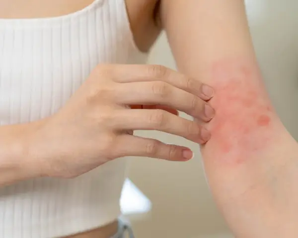 Une personne se gratte le bras, montrant une éruption cutanée rouge. Cela pourrait être un symptôme d'allergie orange.