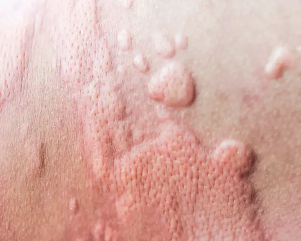 Peau rougie avec des boutons, signe d'urticaire due à la chaleur et à la transpiration.