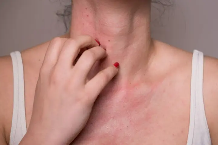 Une personne se gratte le cou et la poitrine, montrant une éruption cutanée rouge. Cela pourrait être une allergie noisette.