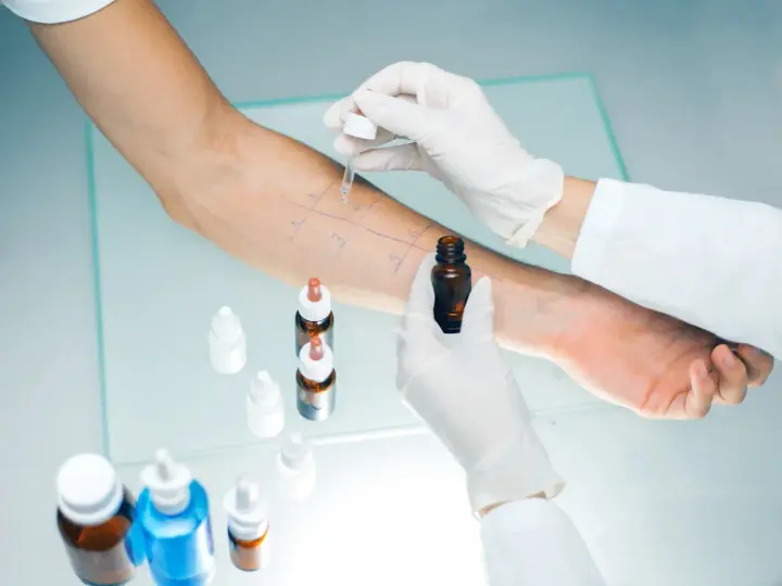 Test cutané pour la **désensibilisation allergies**. Un bras est marqué de cases où des gouttes sont appliquées.