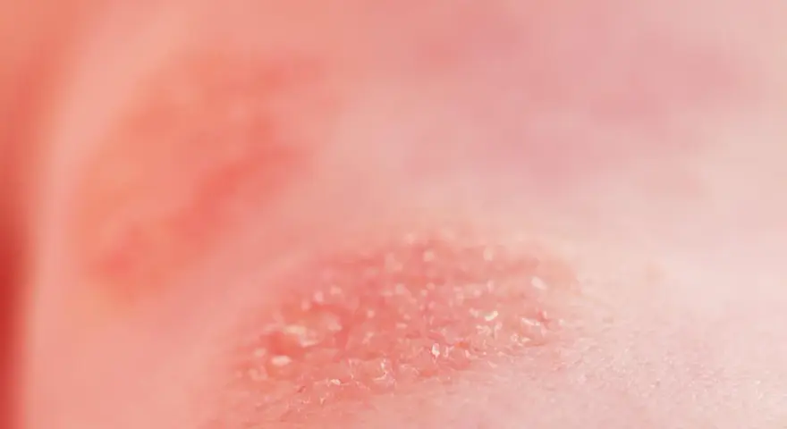 Peau irritée et squameuse, peut-être une allergie au chocolat.