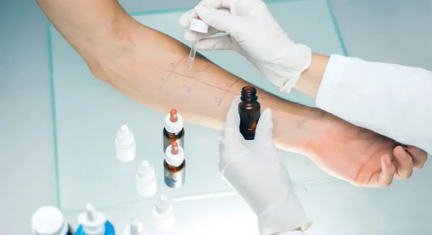 Test cutané pour la **désensibilisation allergies**. Un bras est marqué de cases où des gouttes sont appliquées.