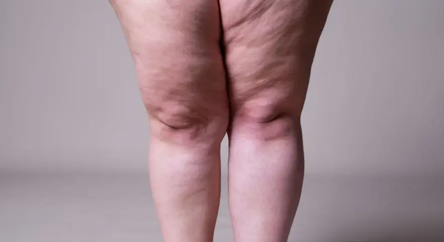 Jambes présentant des signes de lipœdème. Exploration des options de lipœdème traitement naturel pour soulager les symptômes.