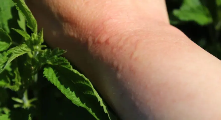 Une peau rougie et irritée suite à une piqure d'ortie, avec des feuilles vertes en premier plan.