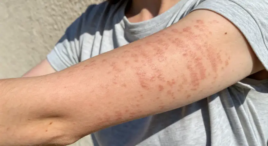Bras couvert de plaques rouges et surélevées, symptômes d'une allergie cutanée urticaire.