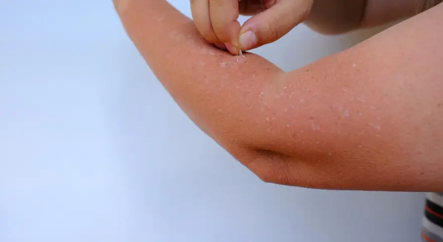 Peau qui pèle sur un bras, peut-être une allergie clementine. Un doigt retire des squames.