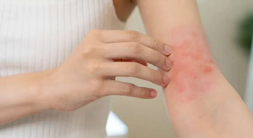 Une personne se gratte le bras, montrant une éruption cutanée rouge. Cela pourrait être un symptôme d'allergie orange.