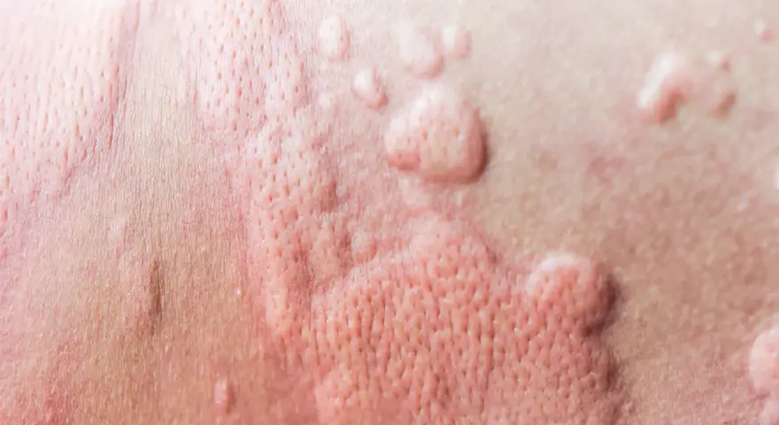 Peau rougie avec des boutons, signe d'urticaire due à la chaleur et à la transpiration.