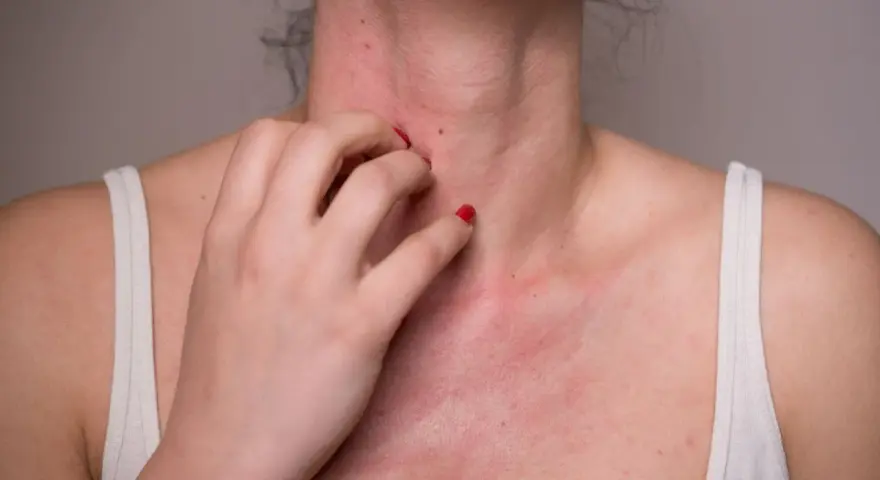 Une personne se gratte le cou et la poitrine, montrant une éruption cutanée rouge. Cela pourrait être une allergie noisette.