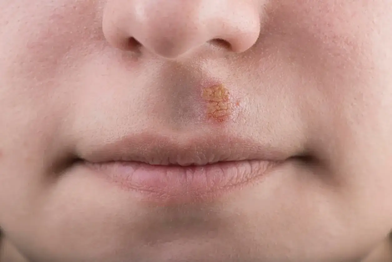 Gros plan sur un bouton de fi&egrave;vre sur le nez, &eacute;voquant un rem&egrave;de de grand-m&egrave;re pour le soulager.