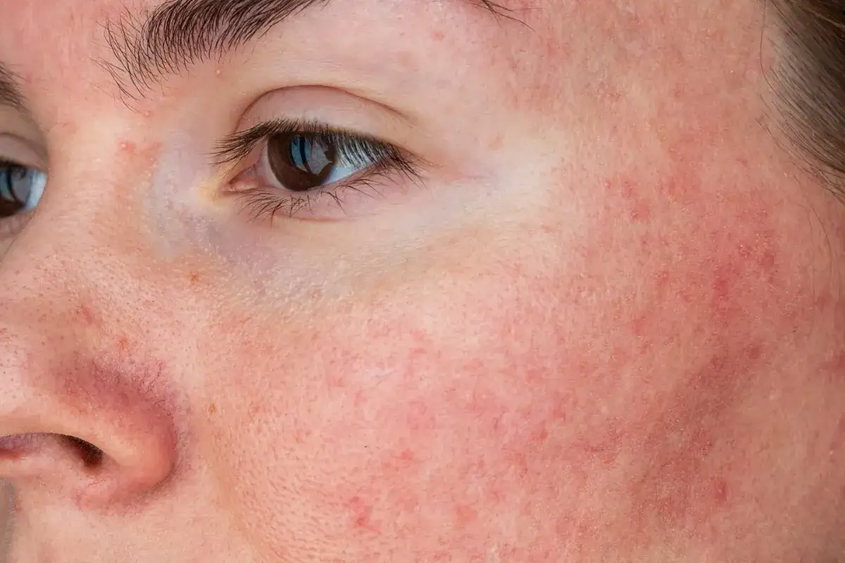 Peau rougie et irrit&eacute;e, avec des petits boutons, possiblement une allergie au collag&egrave;ne.