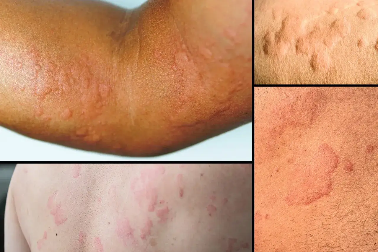 Plusieurs parties du corps montrent des rougeurs et des gonflements caract&eacute;ristiques d'une allergie cutan&eacute;e urticaire.