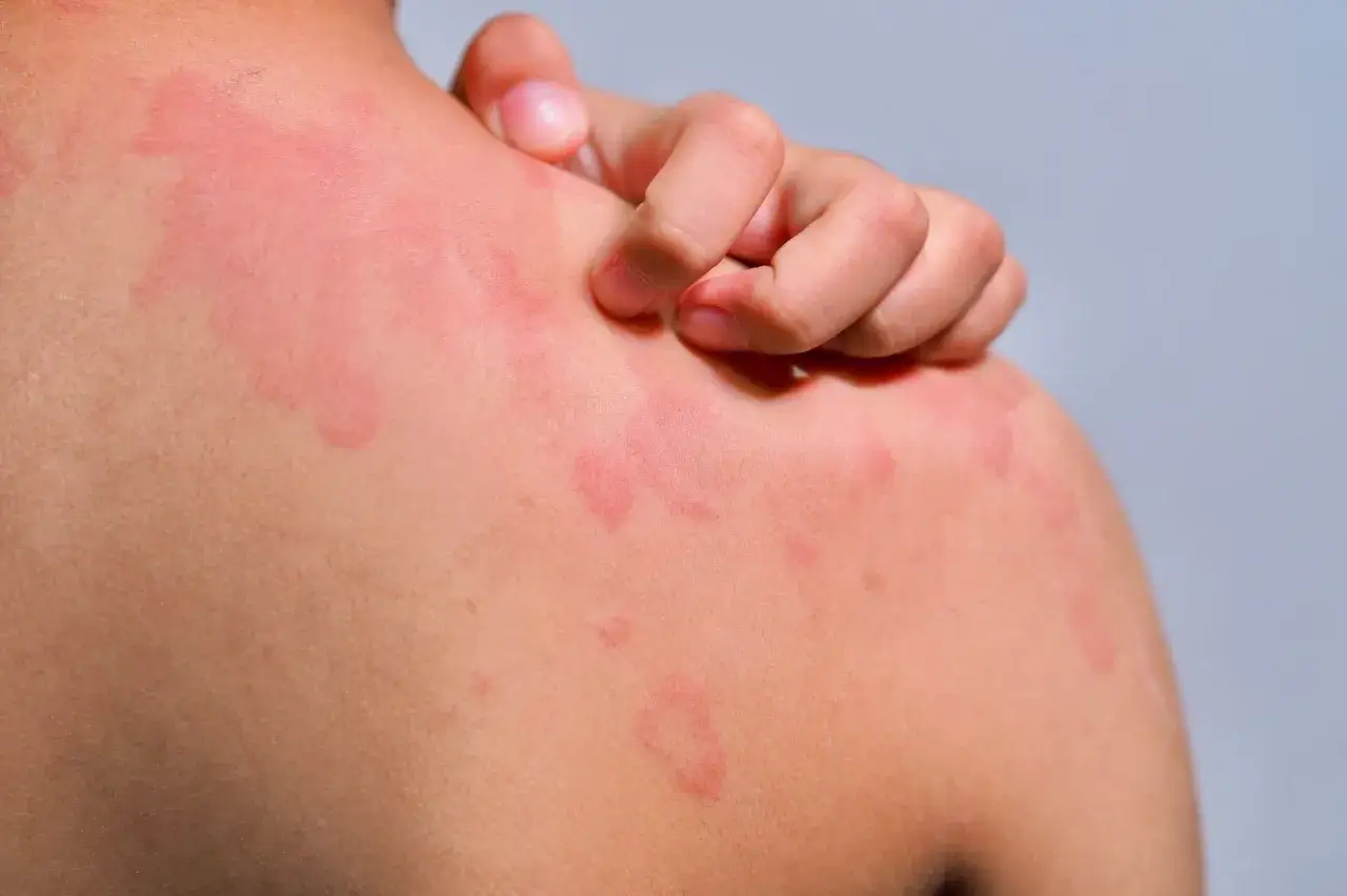Une personne se gratte l'&eacute;paule couverte de plaques rouges, signe d'une urticaire due &agrave; la transpiration et &agrave; la chaleur.
