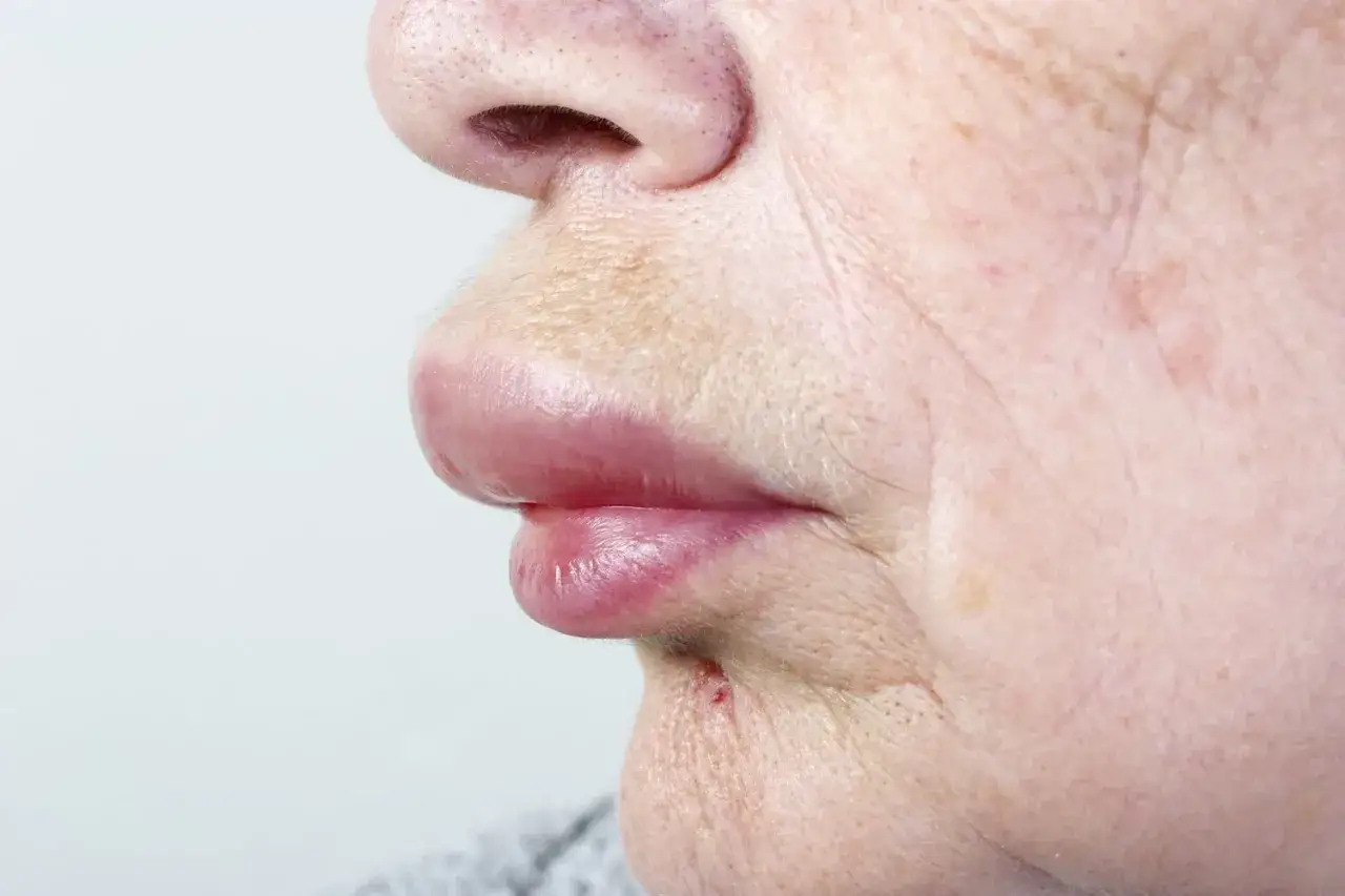 L&egrave;vres gonfl&eacute;es et rouges, signe possible d'une allergie &agrave; la banane.