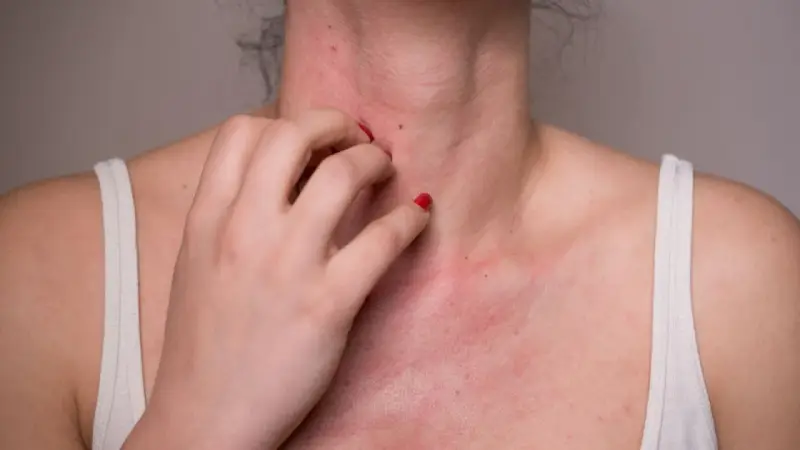 Une personne se gratte le cou et la poitrine, montrant une éruption cutanée rouge. Cela pourrait être une allergie noisette.